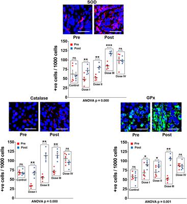 A pro-oxidant combination of resveratrol and copper down-regulates hallmarks of cancer and immune checkpoints in patients with advanced oral cancer: Results of an exploratory study (RESCU 004)